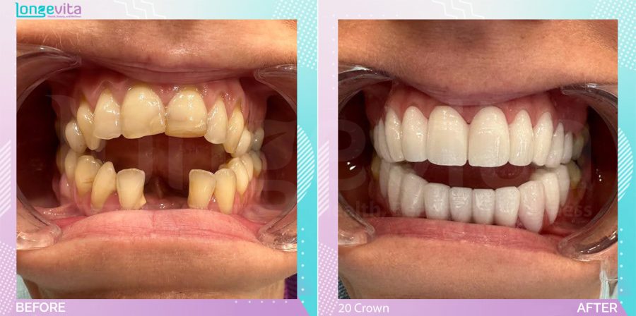 Crowns and Hollywood Smile before and after, 20 Porcelain Crown units, 40s female patient