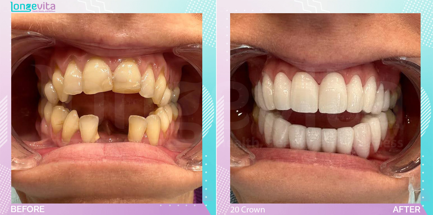 Crowns and Hollywood Smile before and after, 20 Porcelain Crown units, 40s female patient