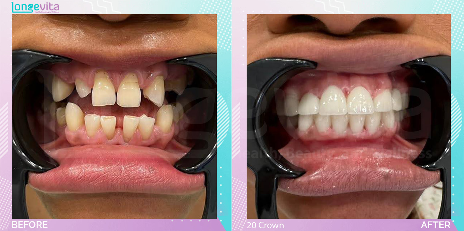 Crowns and Hollywood Smile before and after, 20 Porcelain Crown units, 50s female patient