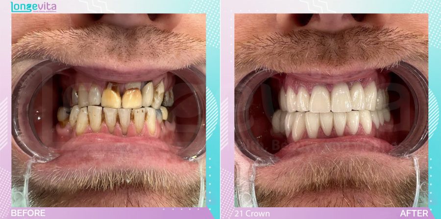 Crowns and Hollywood Smile before and after, 21 Porcelain Crown units
