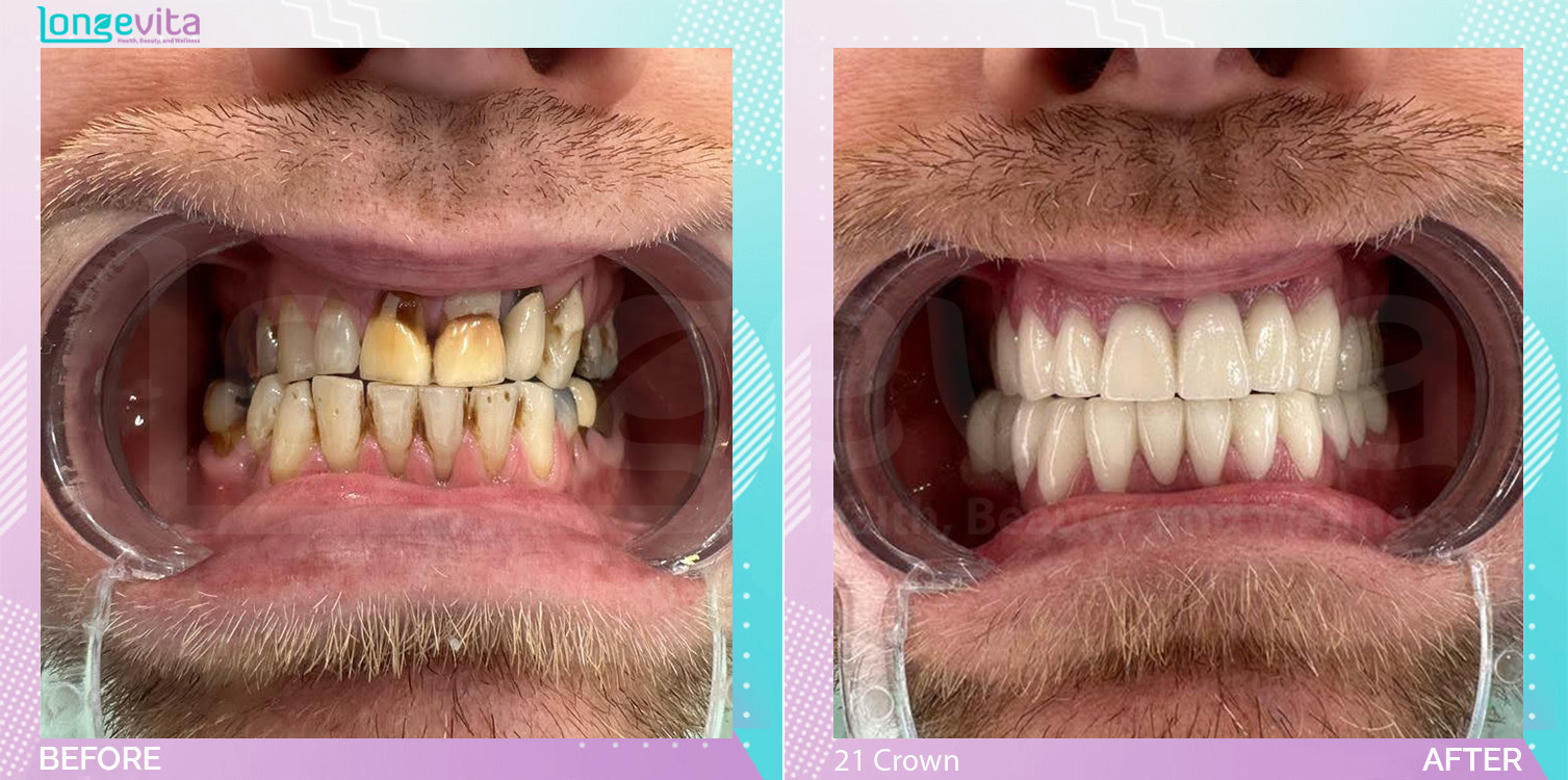 Crowns and Hollywood Smile before and after, 21 Porcelain Crown units