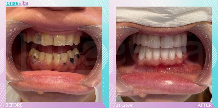 Crowns before and after, 15 Porcelain Crowns units, 30s female patient