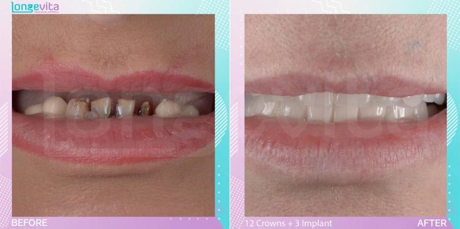 Crowns before and after, 12 Porcelain Crowns + 3 Dental Implant units, 40s female patient