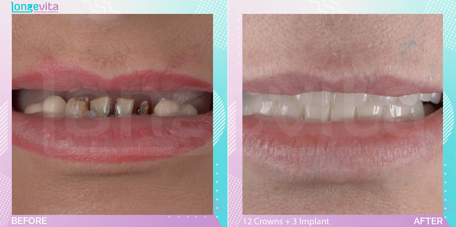 Crowns before and after, 12 Porcelain Crowns + 3 Dental Implant units, 40s female patient