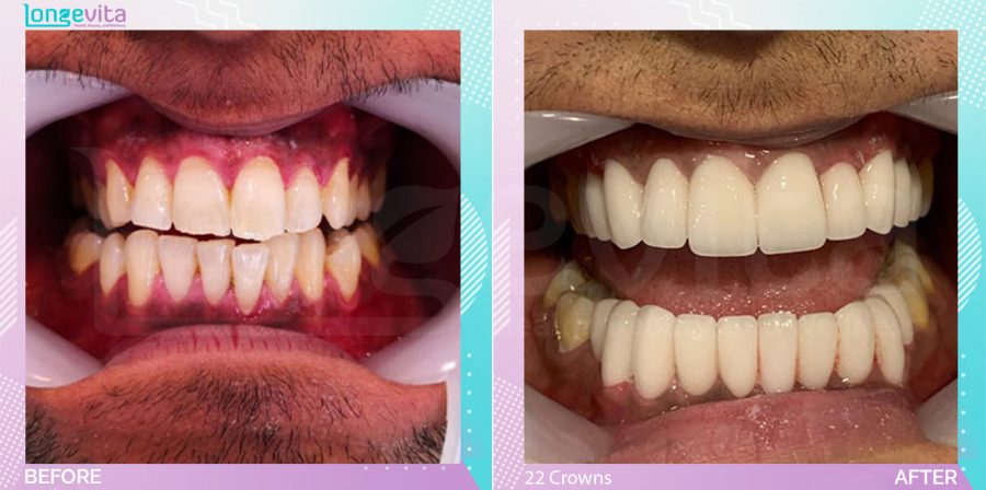 Crowns and Hollywood Smile and Root Canal before and after, 22 Porcelain Crowns + 2 Root Canal units, 30s male patient