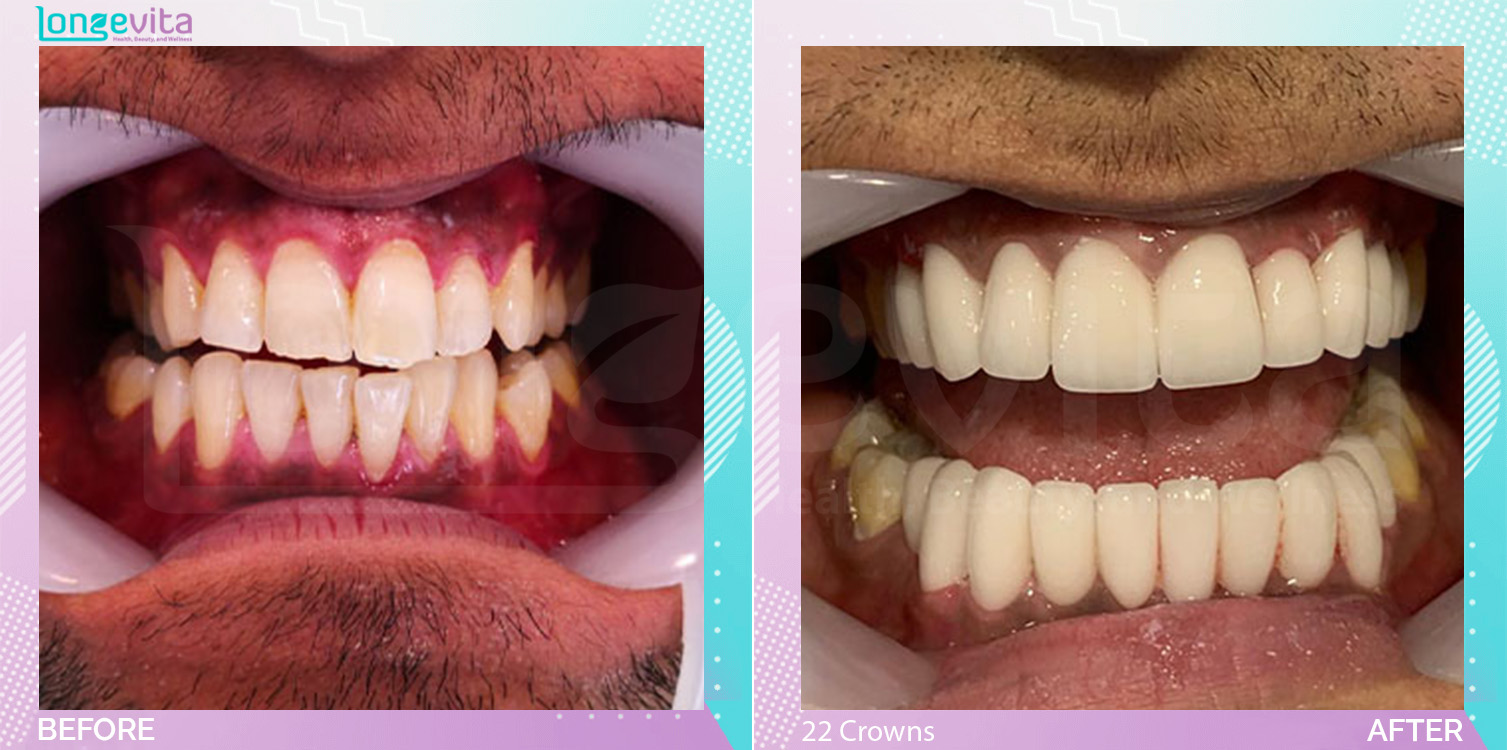 Crowns and Hollywood Smile and Root Canal before and after, 22 Porcelain Crowns + 2 Root Canal units, 30s male patient