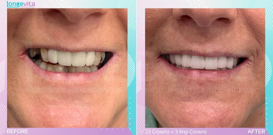 Crowns and Hollywood Smile and Implant Crown and Root Canal before and after, 23 Porcelain Crowns + 3 Implant Crowns + Root Canal + bone augmentation + 2 implant + 2 sinus lift + extraction units, 40s female patient