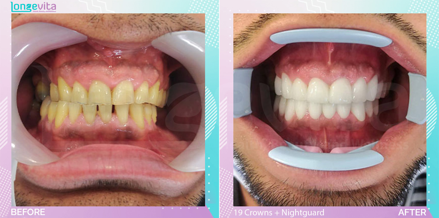 Crowns and Nightguard before and after, 19 Porcelain Crowns+ Nightguard units, 30s male patient