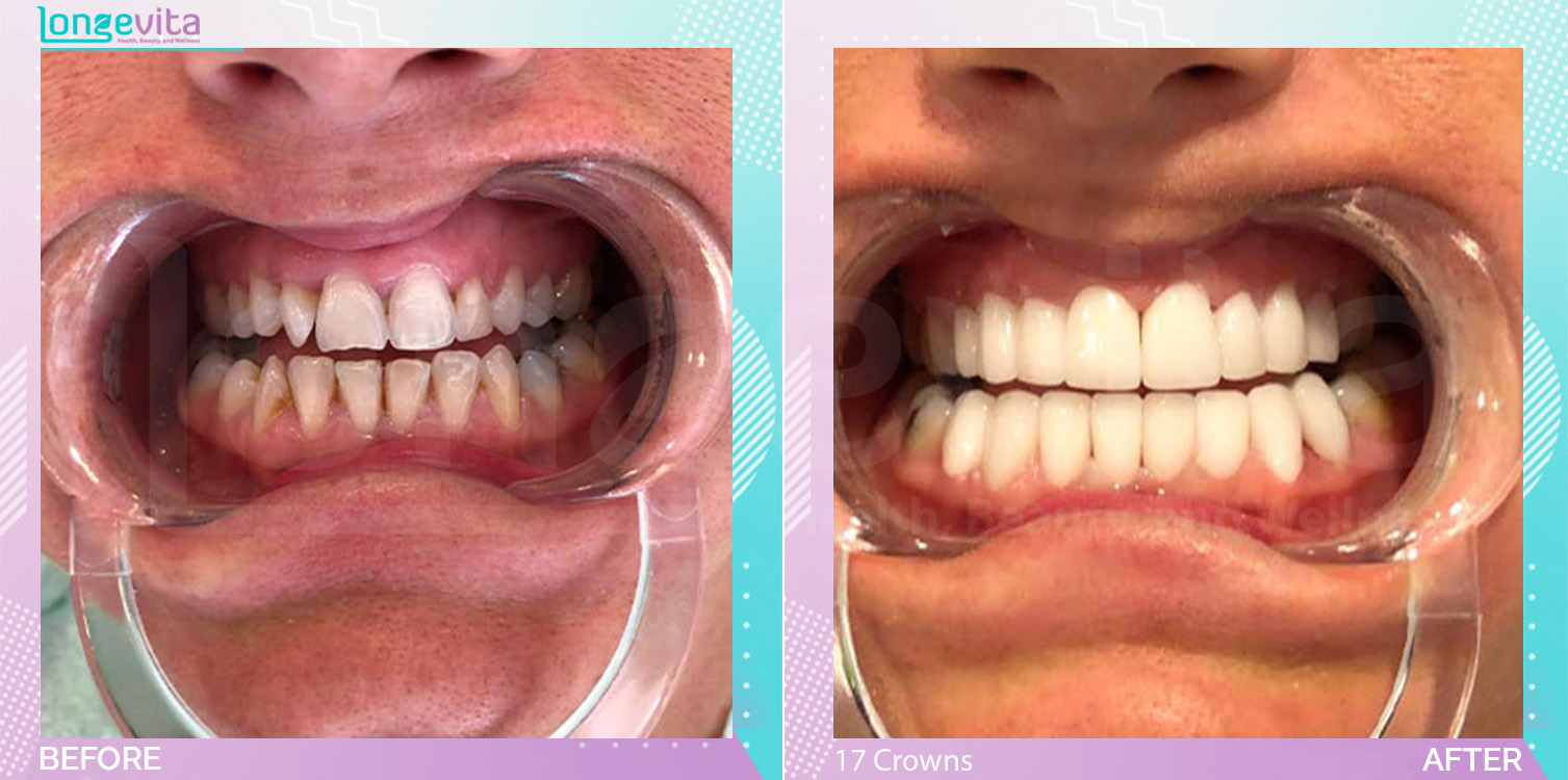 Crowns before and after, 17 Porcelain Crowns units, 30s male patient