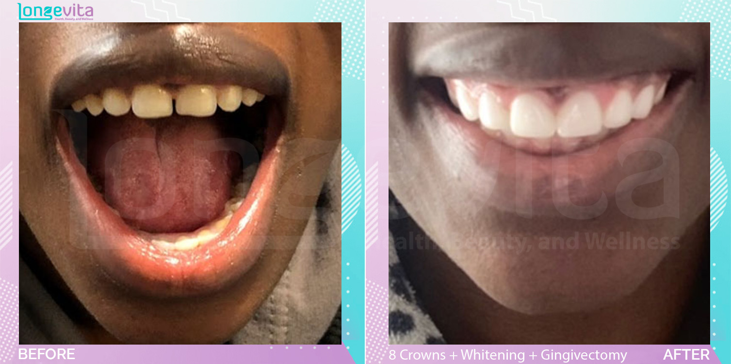 Crowns and Gingivectomy and Whitening before and after, 8 Porcelain Crowns  + teeth whitening + Gingivectomy units, 20s female patient