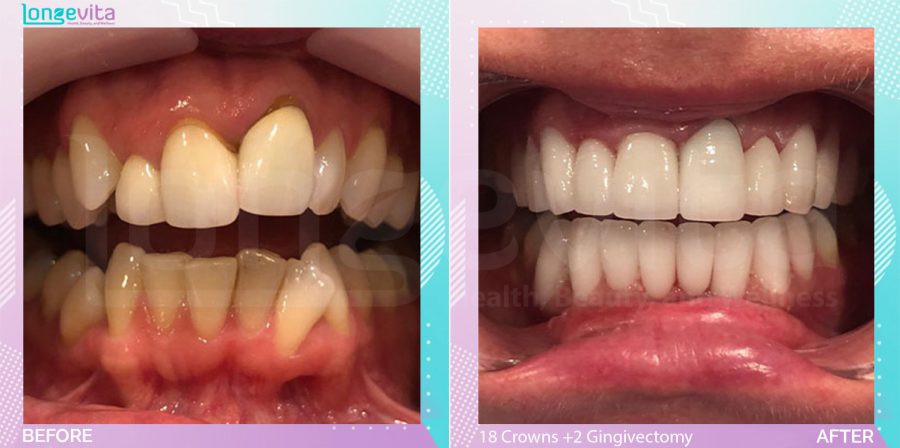 Crowns and Gingivectomy before and after, 18 Porcelain Crowns +2 Gingivectomy units, 30s female patient