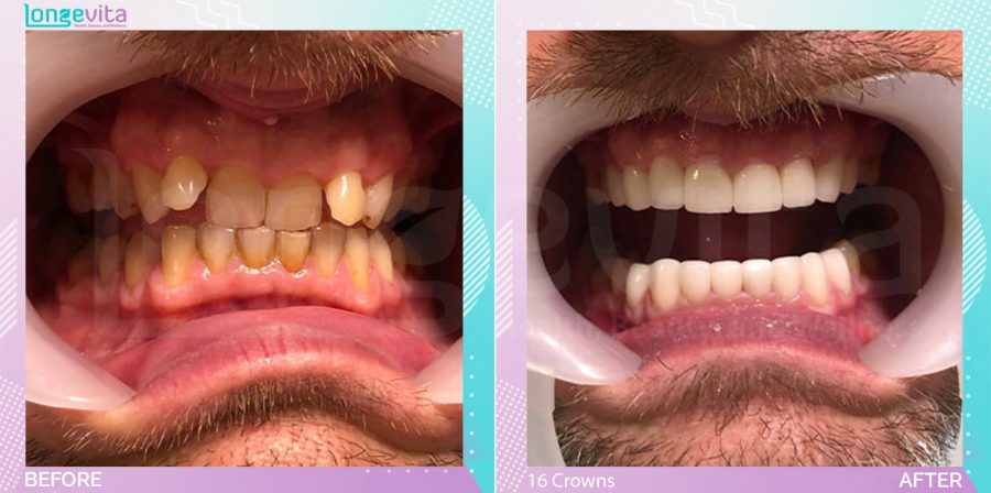 Crowns before and after, 16 Porcelain Crowns units, 50s male patient