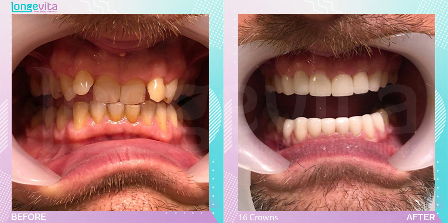 Crowns before and after, 16 Porcelain Crowns units, 50s male patient