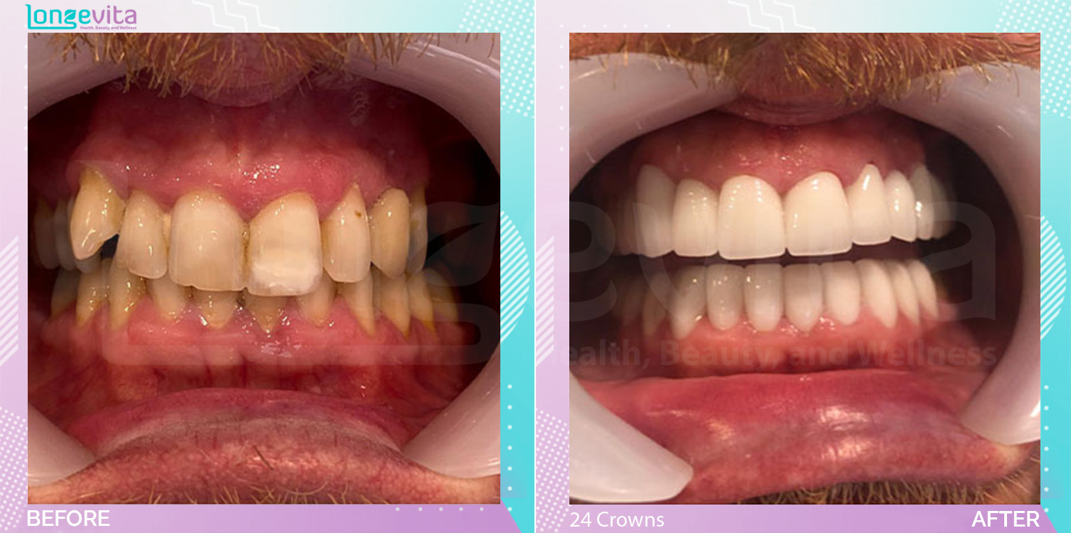 Crowns before and after, 24 Porcelain Crowns units, 40s male patient