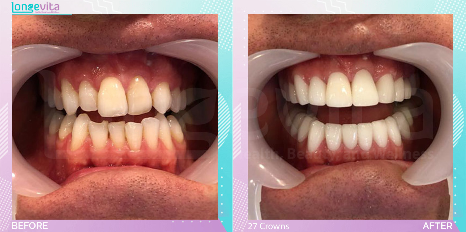 Crowns and Hollywood Smile before and after, 27 Porcelain Crowns units, 40s male patient