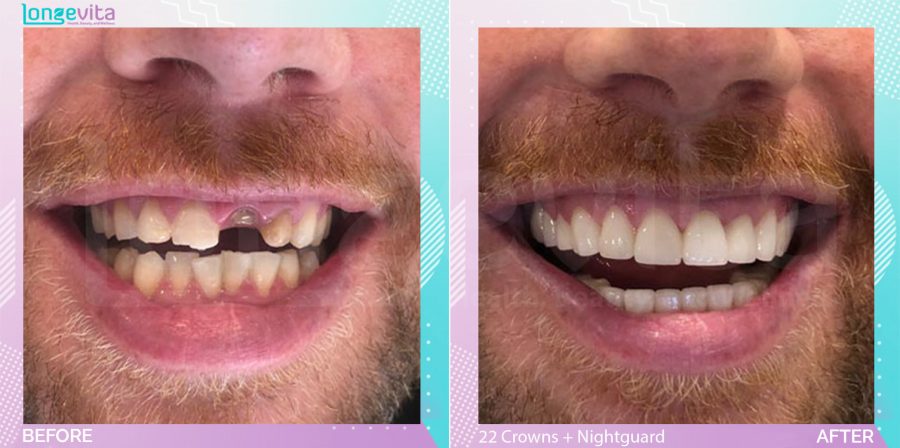 Crowns and Extraction and Hollywood Smile and Nightguard before and after, 22 Porcelain Crowns + Extraction + Nightguard units, 40s male patient