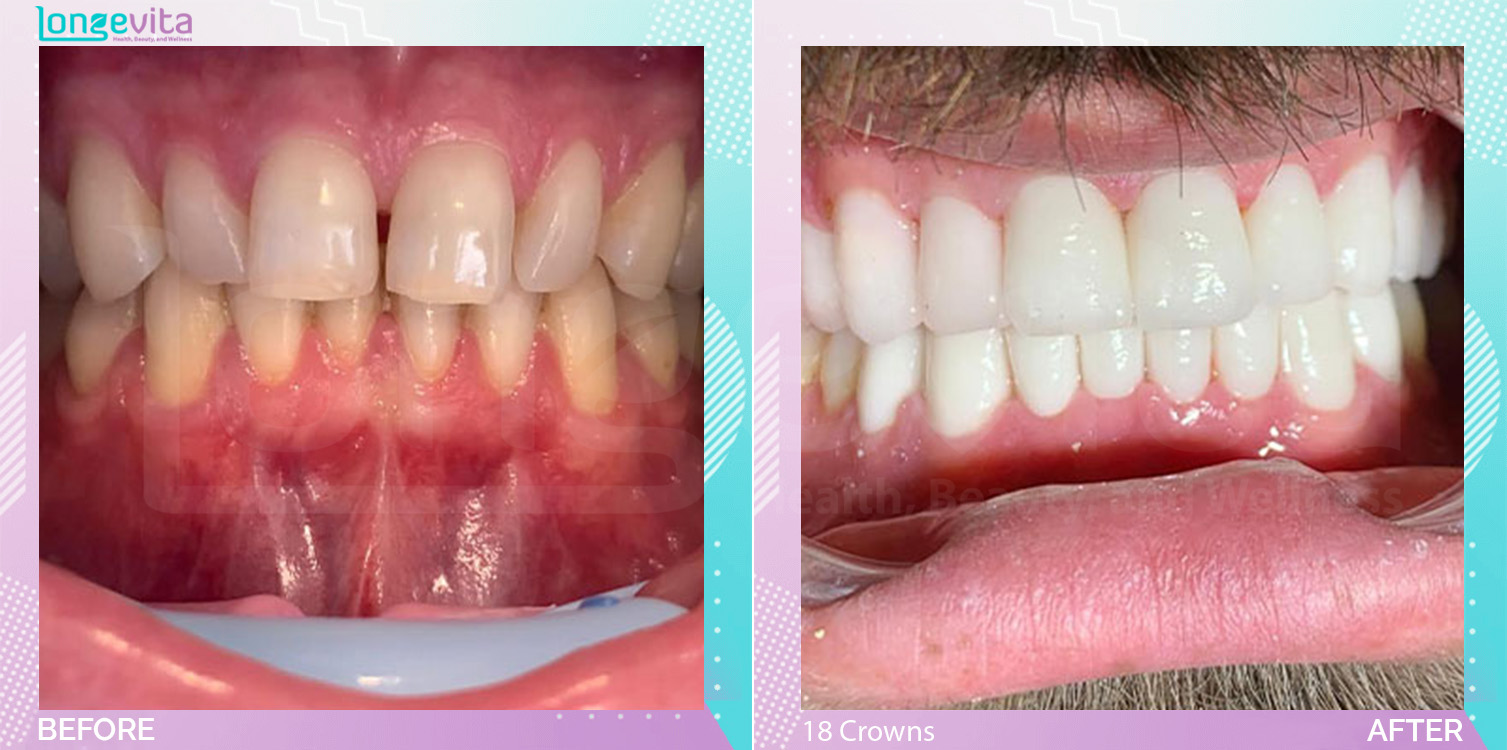 Crowns before and after, 18 Porcelain Crowns units, 20s male patient