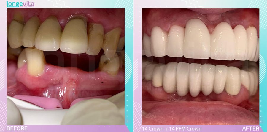 Crowns and Extraction and Fillings and Root Canal before and after, 14 Porcelain Crowns + 14 Porcelain fused to metal Crown + 4 Root Canal + Extraction + 2 filling + units, 50s male patient