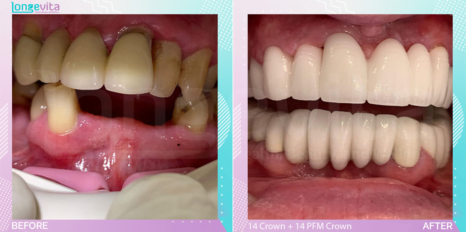 Crowns and Extraction and Fillings and Root Canal before and after, 14 Porcelain Crowns + 14 Porcelain fused to metal Crown + 4 Root Canal + Extraction + 2 filling + units, 50s male patient
