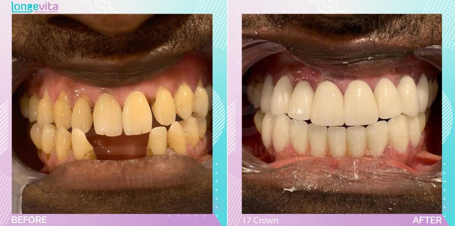 Crowns and Extraction before and after, 17 Porcelain Crown + 2 Extraction units, 40s male patient