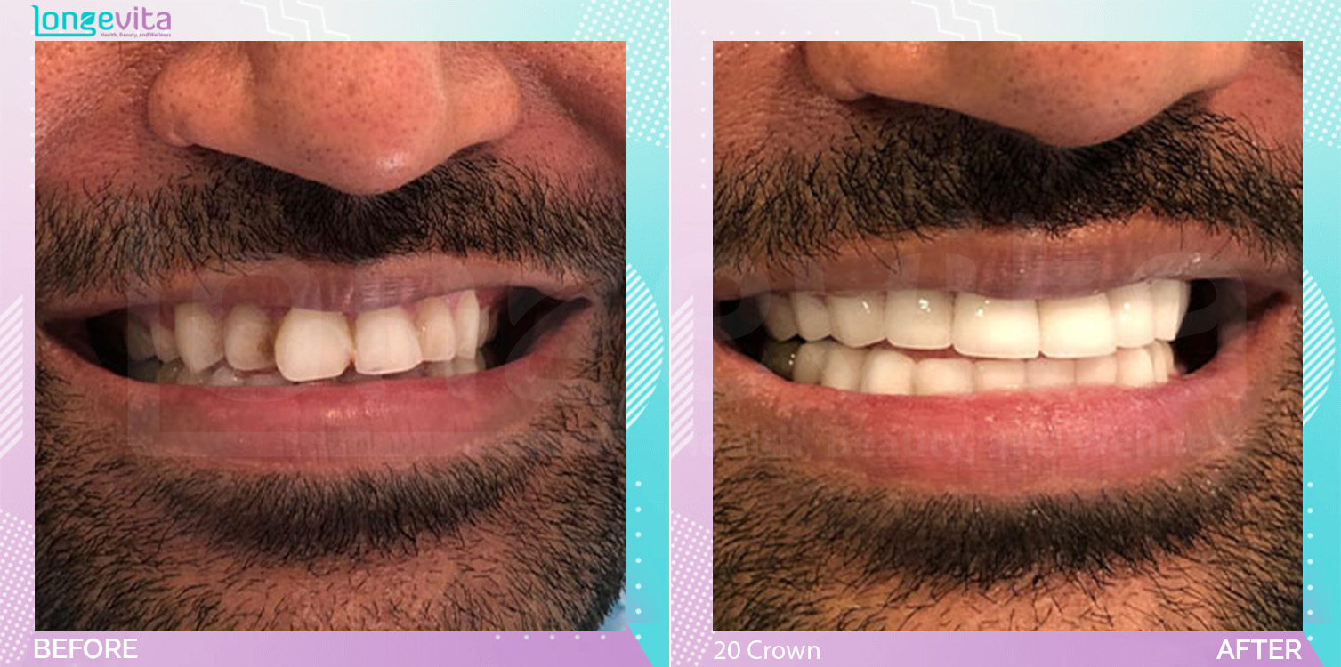 Crowns and Hollywood Smile before and after, 20 Porcelain Crowns units, 30s male patient