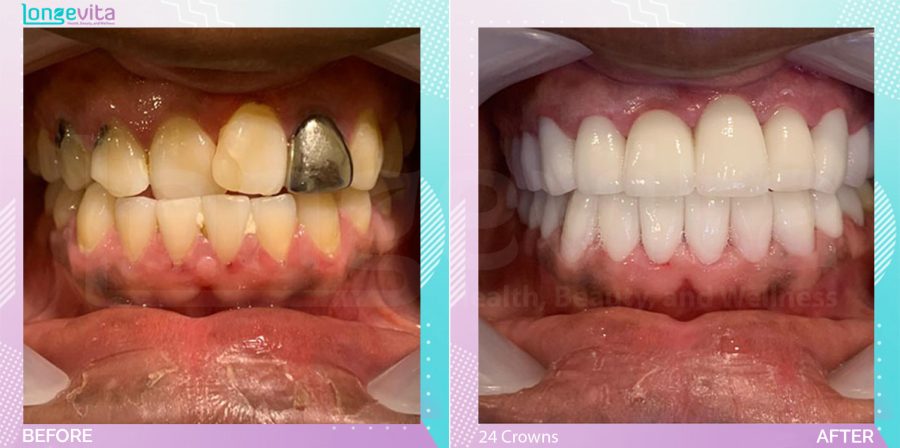Crowns and Extraction and Hollywood Smile before and after, 24 Porcelain Crowns + Extraction units, 20s male patient