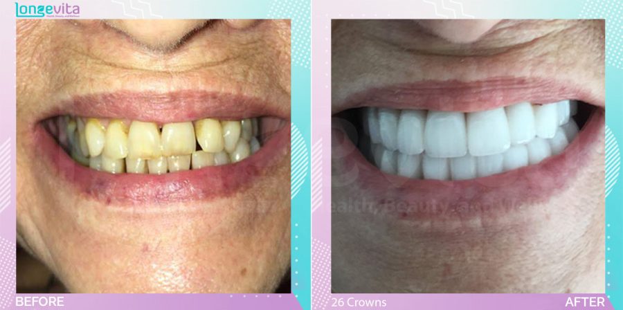 Crowns and Extraction and Hollywood Smile before and after, 26 Porcelain Crowns + Extraction units, 60s female patient