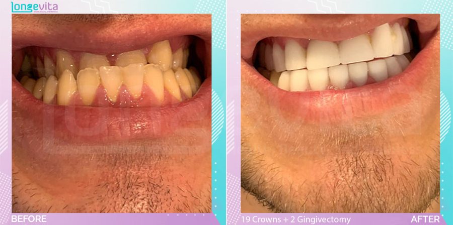 Crowns and Gingivectomy and Nightguard and Root Canal and Scale and Polish before and after, 19 Porcelain Crowns + 2 Root Canal + 2 Gingivectomy + 2 Nightguard + Scale & Polish units, 30s male patient