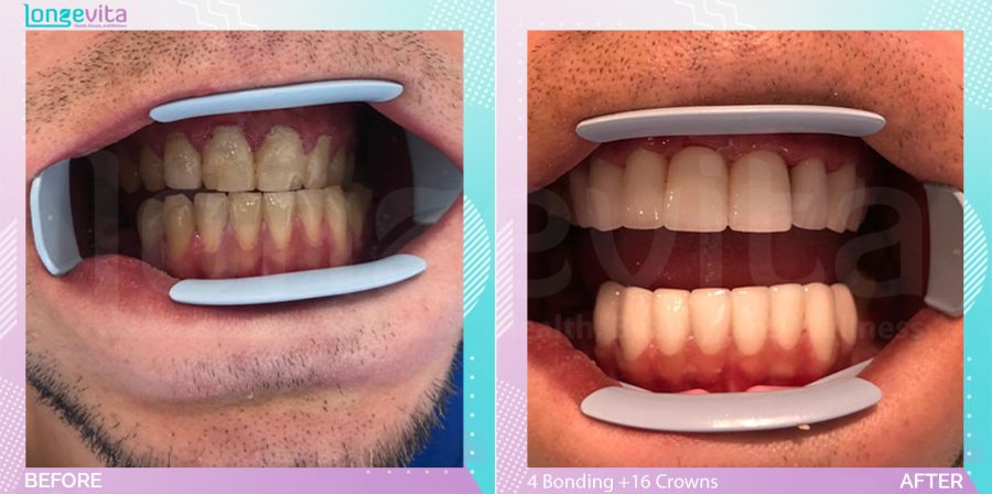 Composite Bonding and Crowns before and after, 4 Composite Bonding + 16 Porcelain Crowns units, 20s male patient