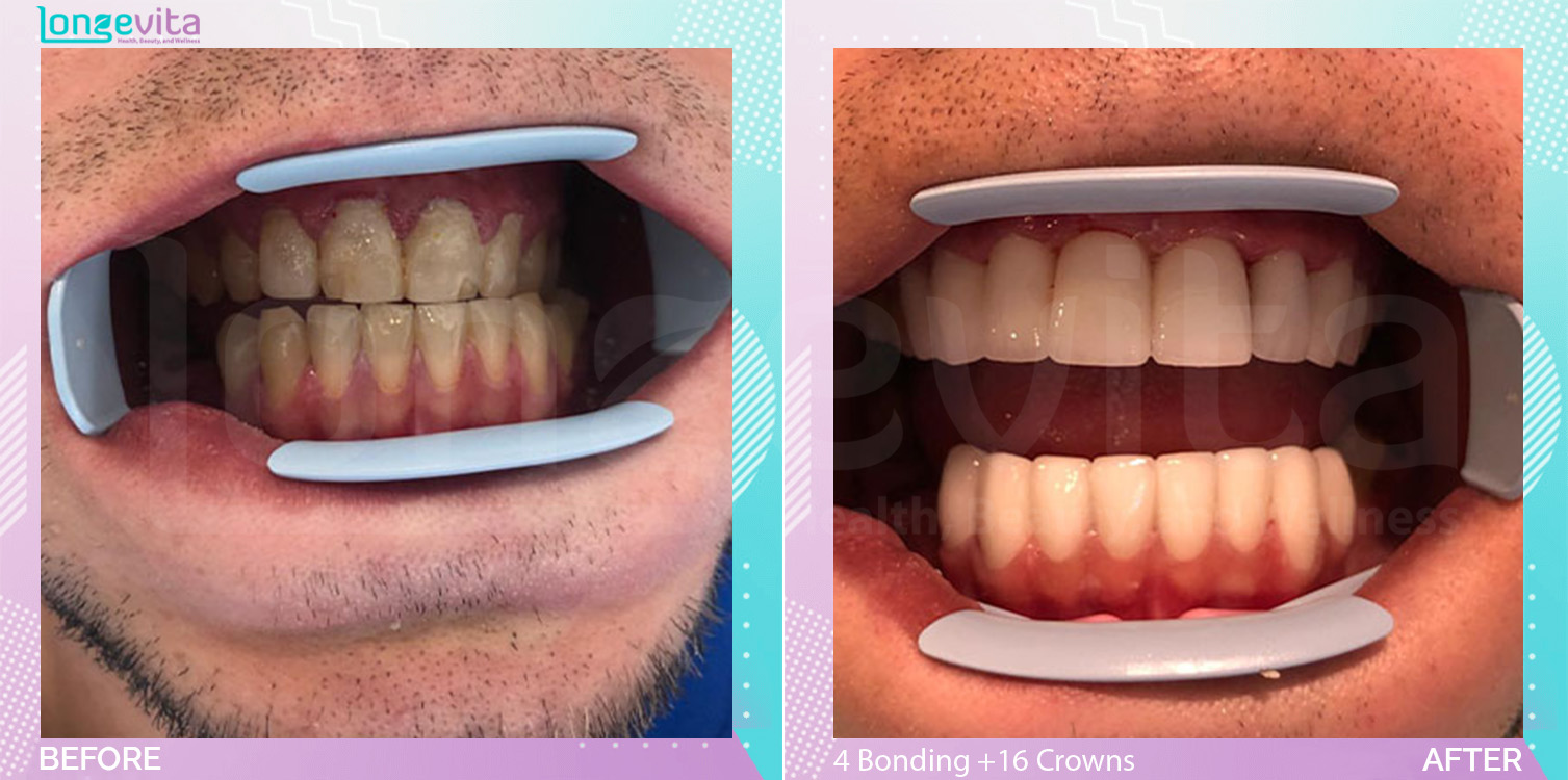 Composite Bonding and Crowns before and after, 4 Composite Bonding + 16 Porcelain Crowns units, 20s male patient