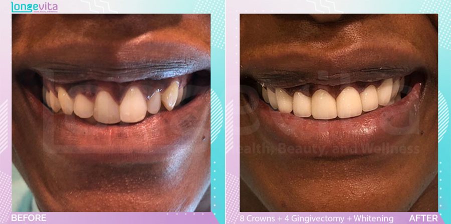 Crowns and Gingivectomy and Whitening before and after, 8 Porcelain Crowns + 4 Gingivectomy + teeth whitening units, 20s female patient