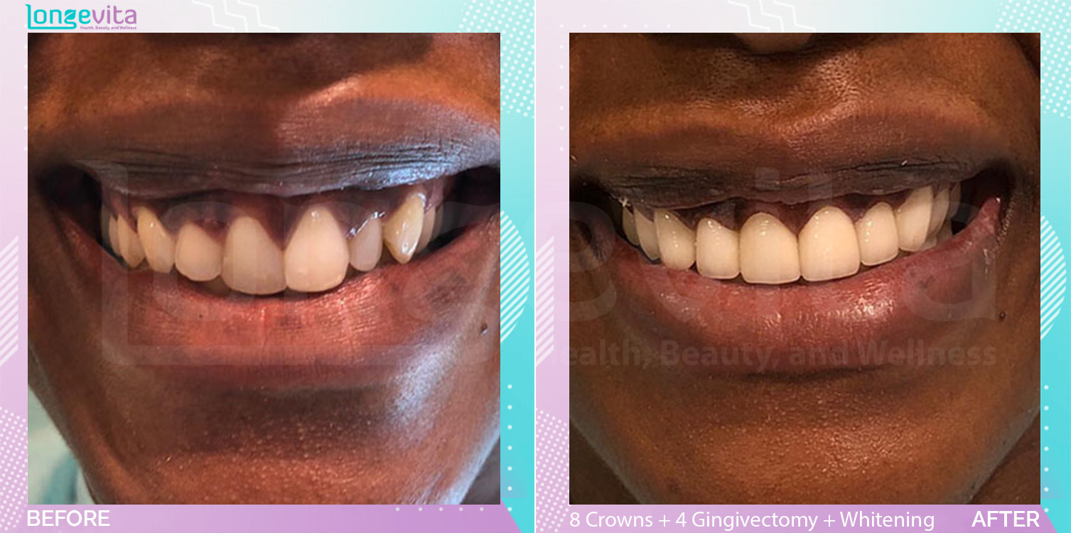 Crowns and Gingivectomy and Whitening before and after, 8 Porcelain Crowns + 4 Gingivectomy + teeth whitening units, 20s female patient