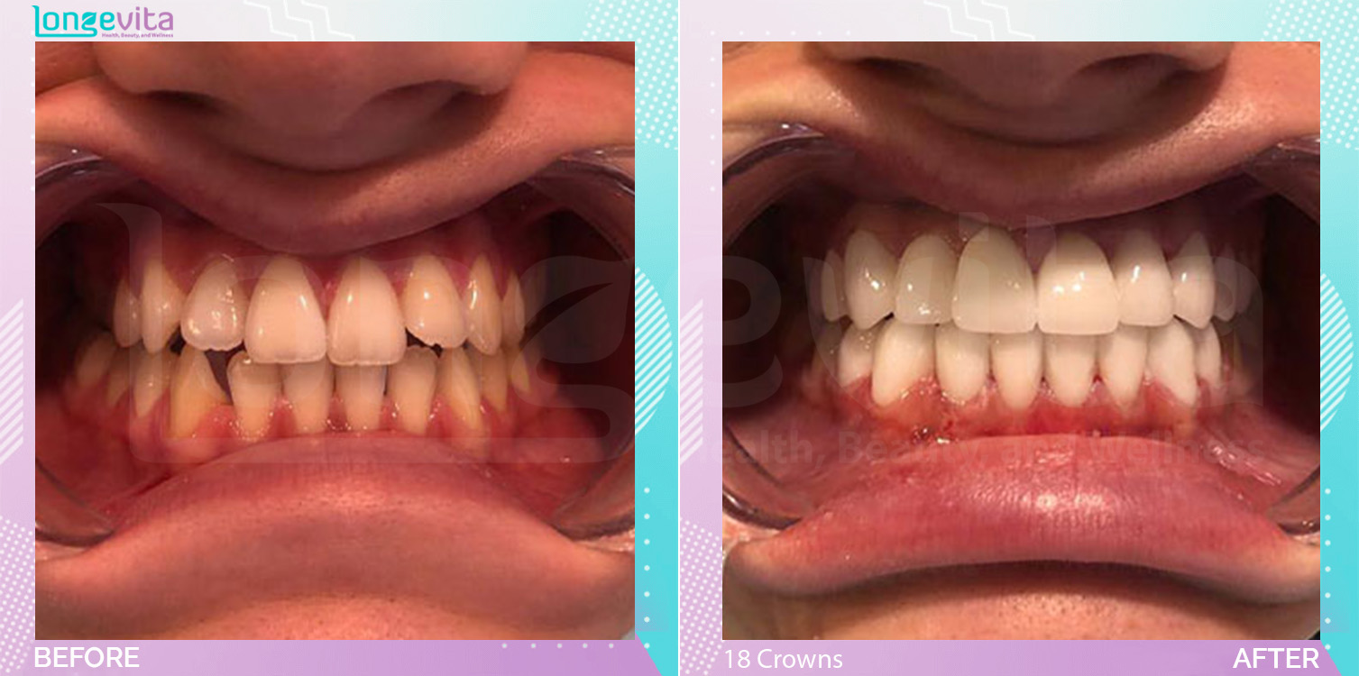 Crowns before and after, 18 Porcelain Crowns units, 20s male patient