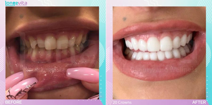 Crowns and Extraction and Fillings and Hollywood Smile and Root Canal before and after, 20 Porcelain Crowns + Root Canal + 3 Extraction + 2 Filling units, 20s female patient