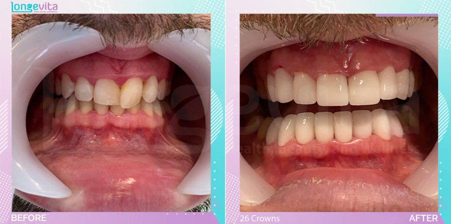 Crowns and Hollywood Smile before and after, 26 Porcelain Crowns units, 30s male patient