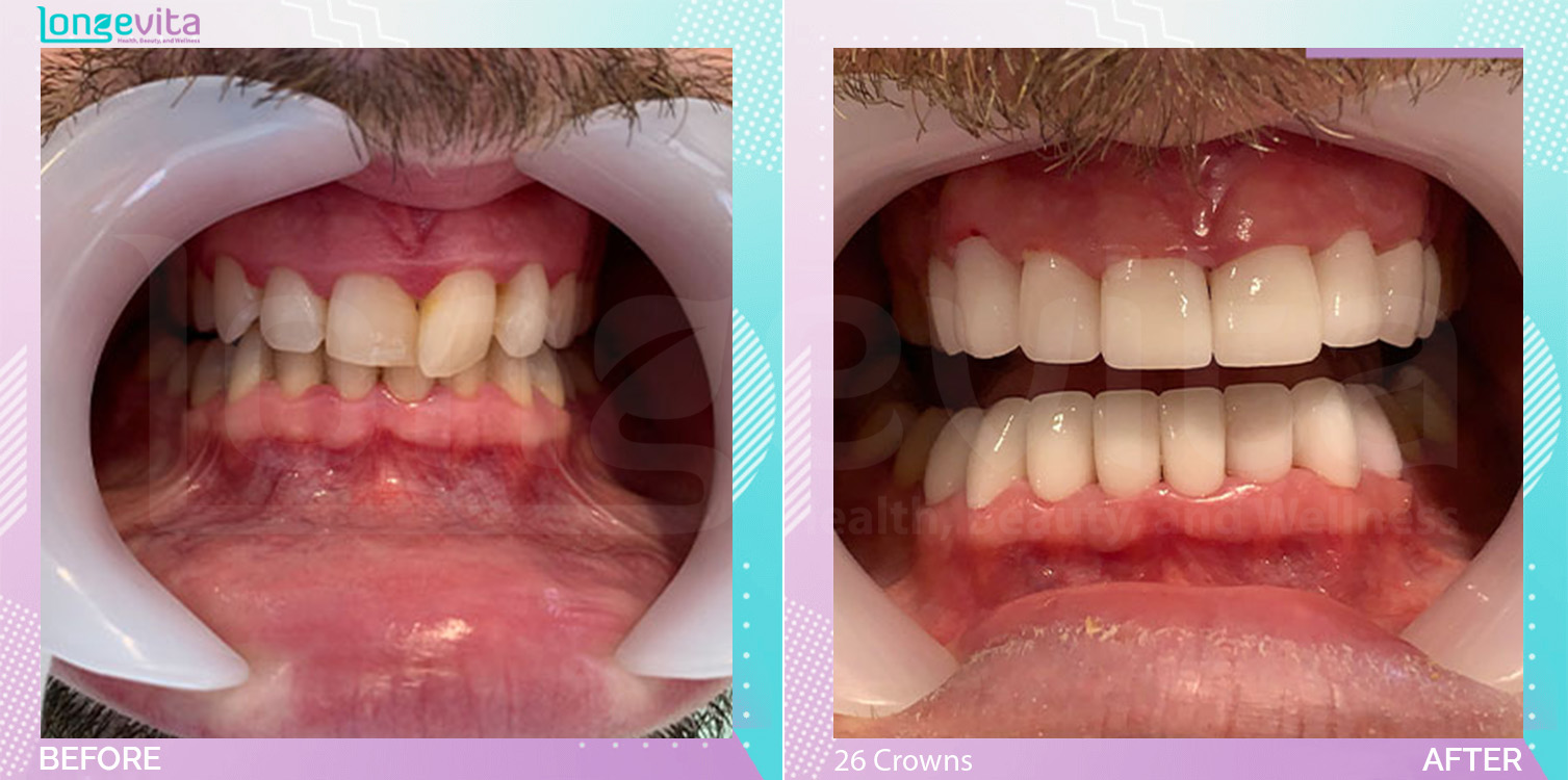 Crowns and Hollywood Smile before and after, 26 Porcelain Crowns units, 30s male patient
