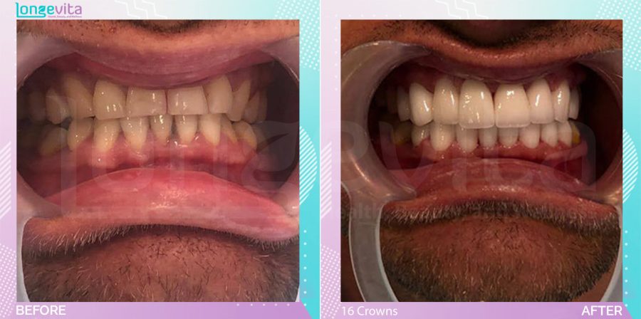 Crowns before and after, 16 Porcelain Crowns units, 30s male patient