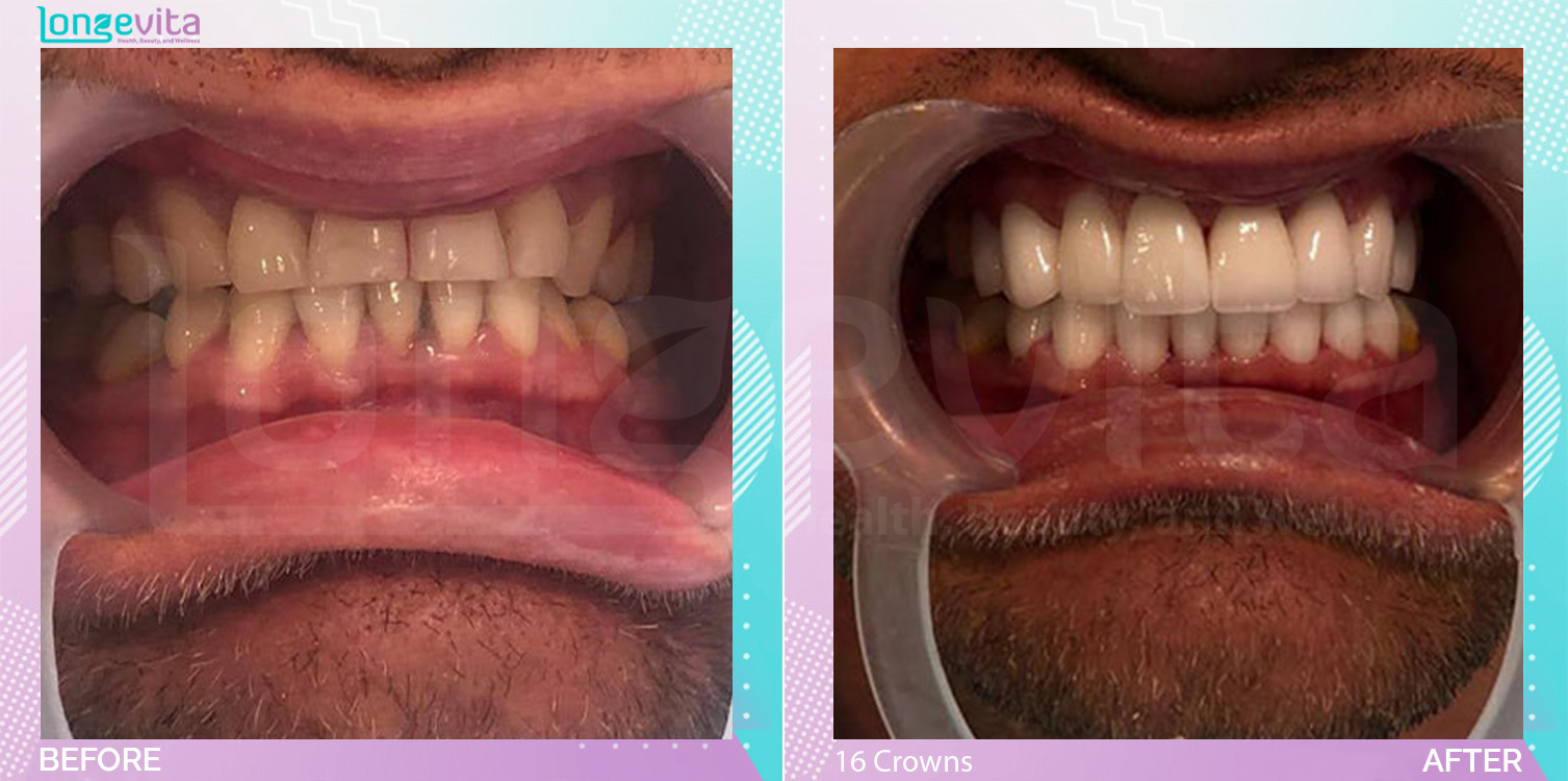 Crowns before and after, 16 Porcelain Crowns units, 30s male patient