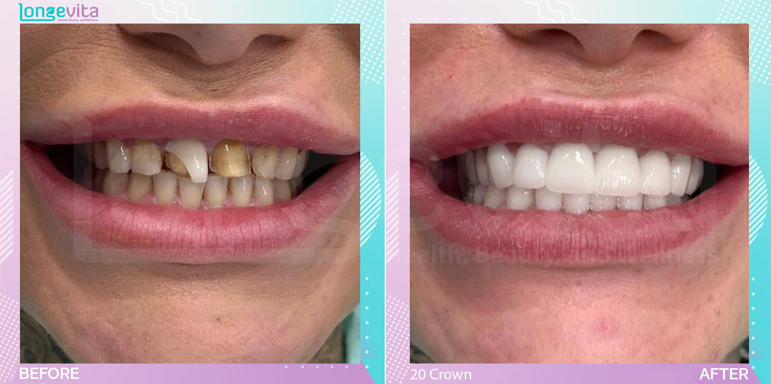 Crowns and Hollywood Smile before and after, 20 Porcelain Crown units, 30s female patient