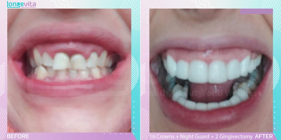 Crowns and Gingivectomy and Nightguard and Root Canal before and after, 16 Porcelain Crowns + Root Canal + Night Guard + 2 Gingivectomy units, 30s female patient