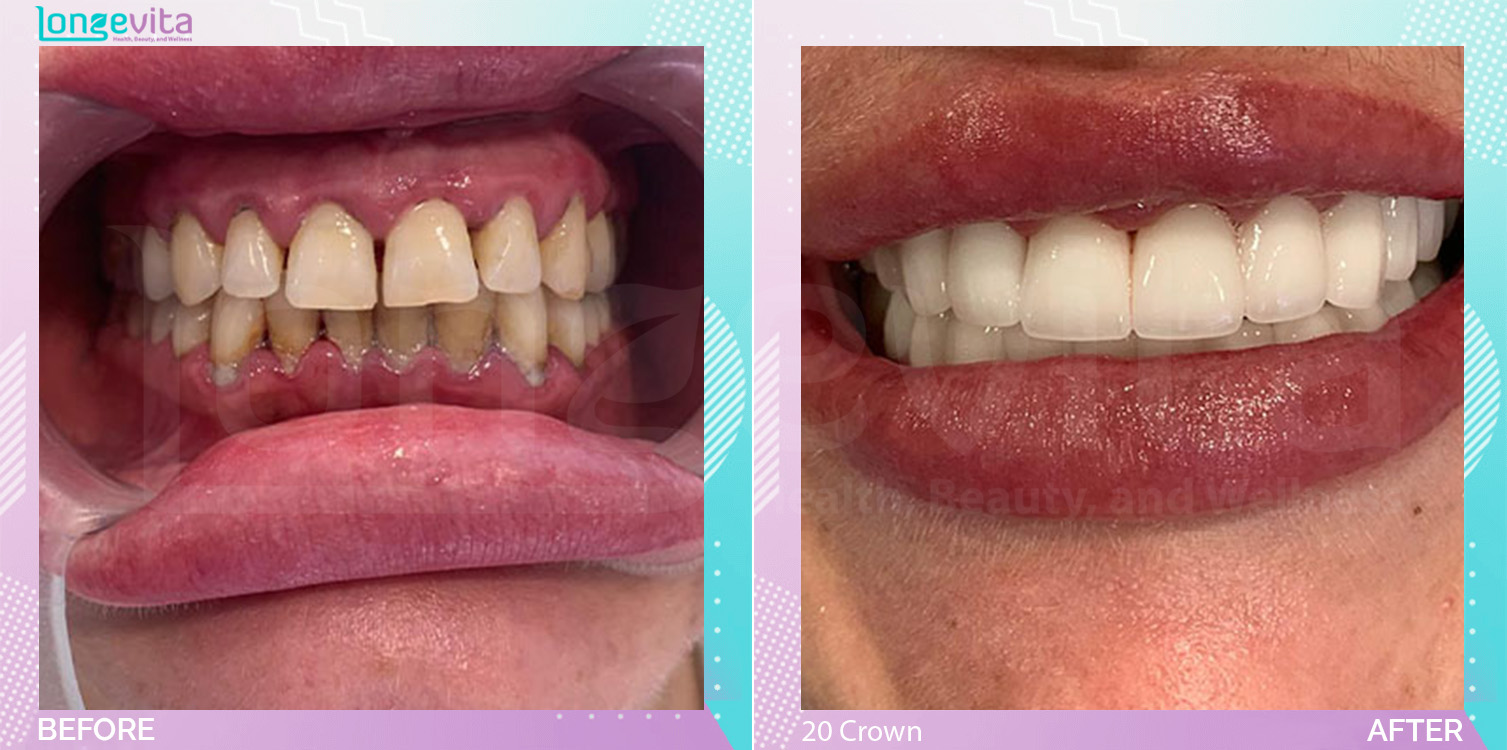 Crowns and Extraction and Hollywood Smile and Root Canal before and after, 20 Porcelain Crowns + Root canal + 2 Extraction units, 20s female patient