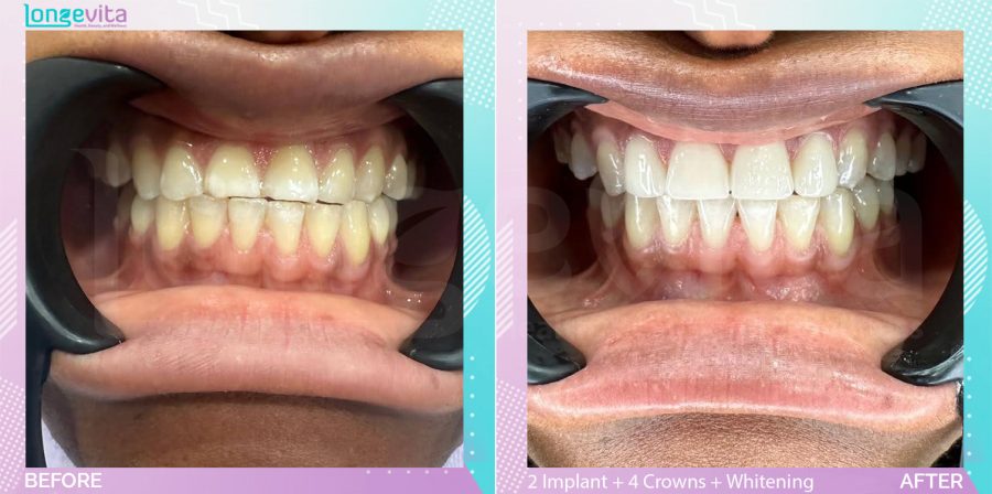 Crowns and Implants and Whitening before and after, 2 Dental Implant + 4 Porcelain Crowns + Teeth Whitening units, 30s female patient