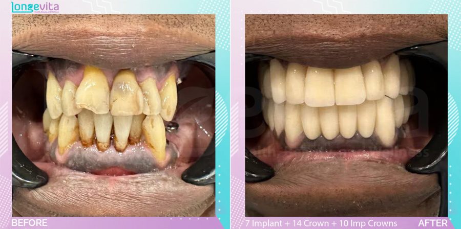 Crowns and Extraction and Implant Crown and Implants before and after, 7 Implant + 17 Extraction + 14 Porcelain Crown + 10 Implant Crowns units, 50s male patient
