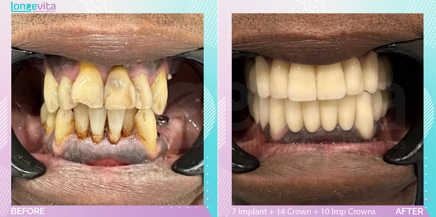 Crowns and Extraction and Implant Crown and Implants before and after, 7 Implant + 17 Extraction + 14 Porcelain Crown + 10 Implant Crowns units, 50s male patient