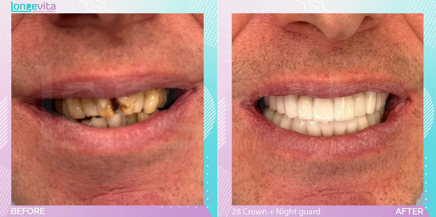 Crowns and Extraction and Hollywood Smile and Nightguard before and after, 28 Porcelain Crown + Nightguard + 3 Extraction units, 50s male patient