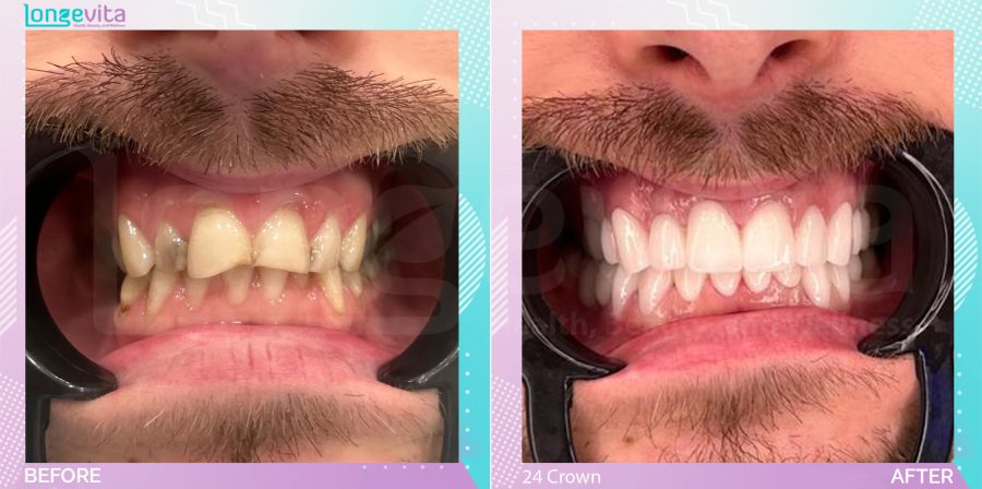 Crowns and Extraction before and after, 24 Porcelain Crown + Extraction units, 30s male patient