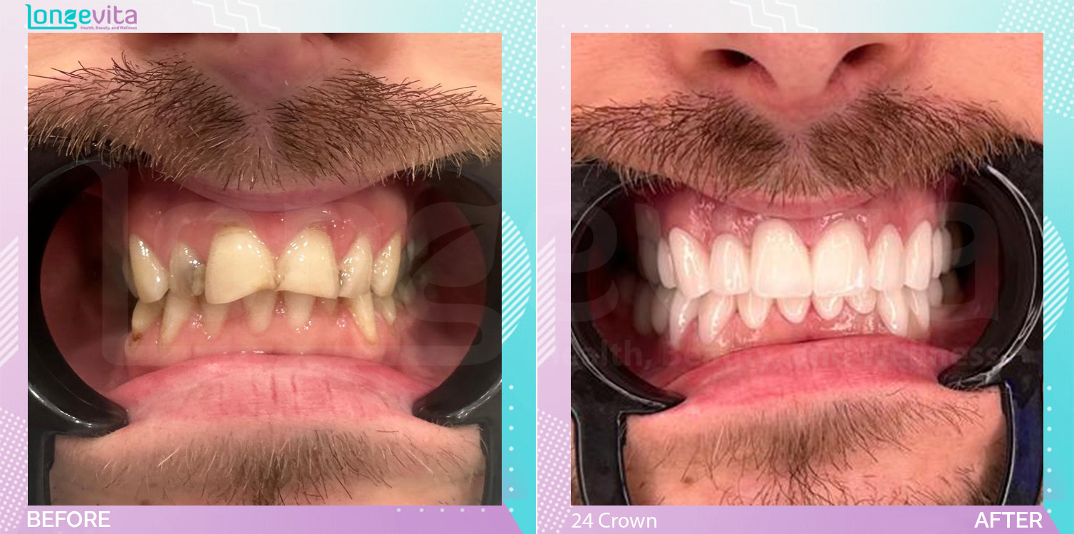 Crowns and Extraction before and after, 24 Porcelain Crown + Extraction units, 30s male patient