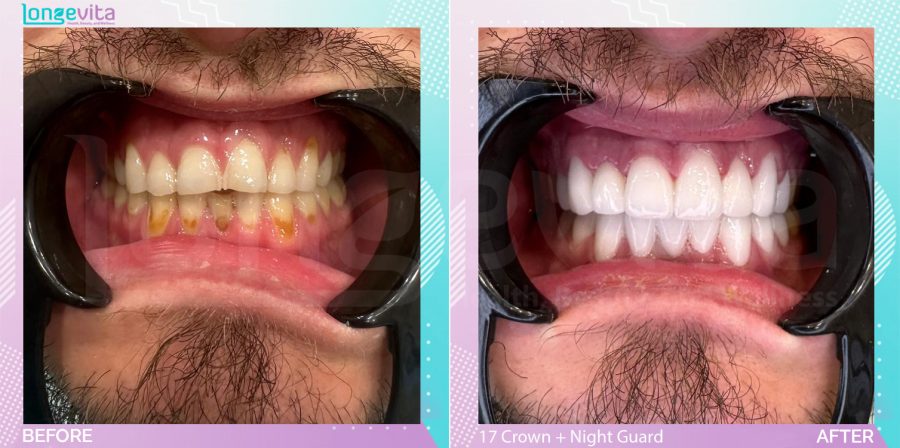 Crowns and Extraction and Fillings and Nightguard before and after, 17 Porcelain Crowns + 2 filling + extraction + nightguard units, 30s male patient