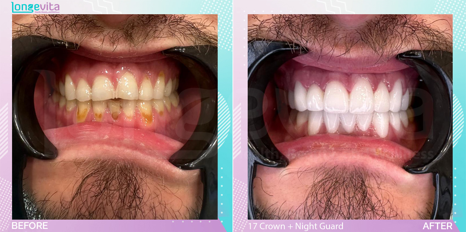 Crowns and Extraction and Fillings and Nightguard before and after, 17 Porcelain Crowns + 2 filling + extraction + nightguard units, 30s male patient