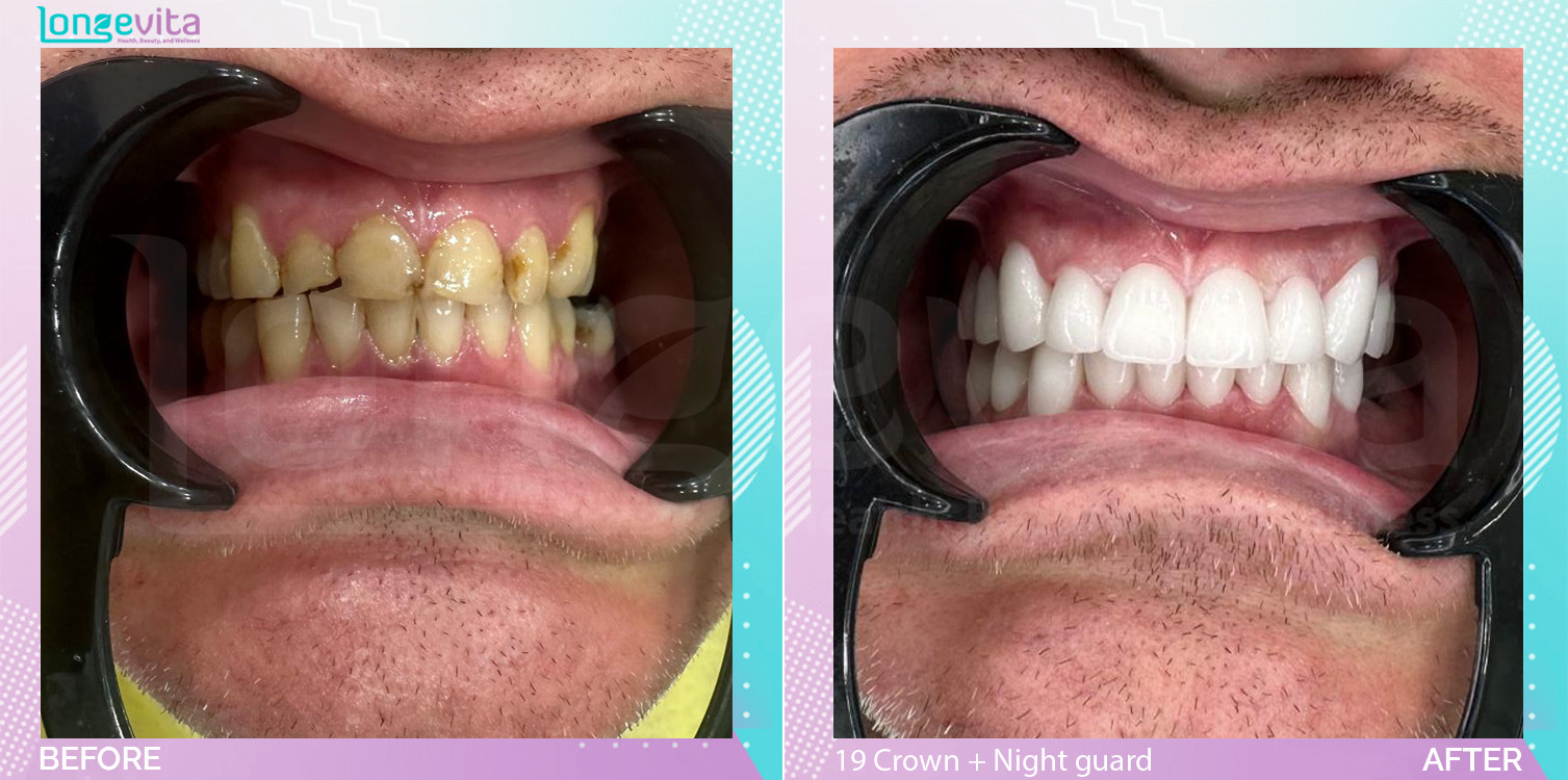 Crowns and Extraction and Nightguard and Root Canal before and after, 1 Root Canal + 1 Extraction + 19 Dental Crowns + Nightguard units, 40s male patient